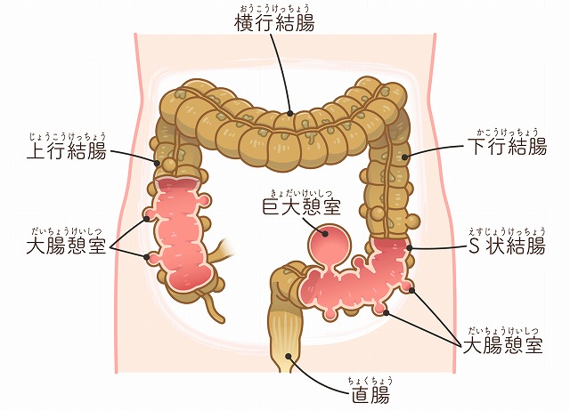 大腸憩室炎とは？