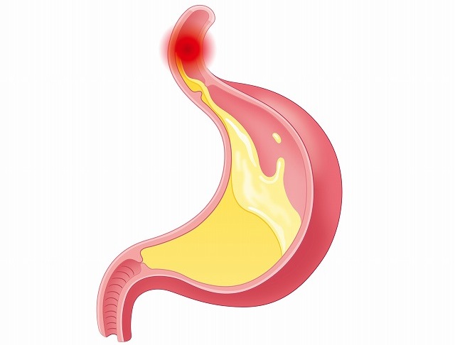 胸やけ・呑酸とは？