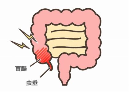 虫垂炎（盲腸炎）とは？