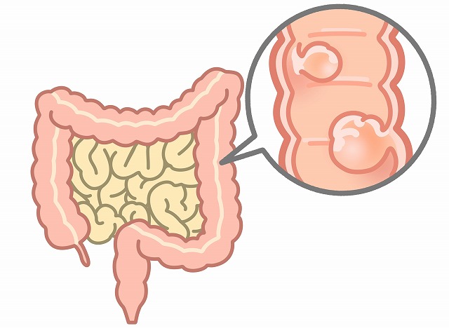 大腸ポリープとは？