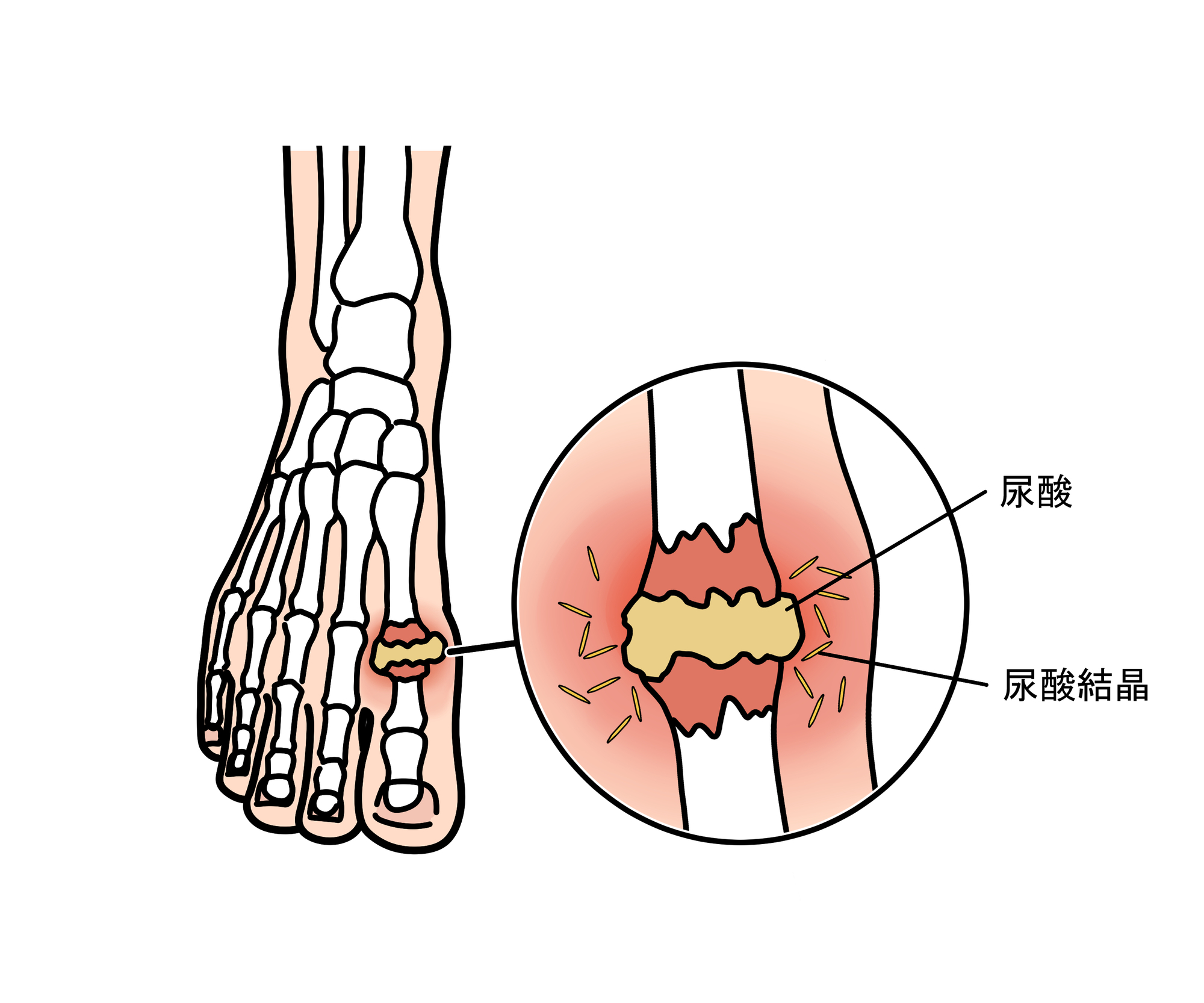 高尿酸血症とは？